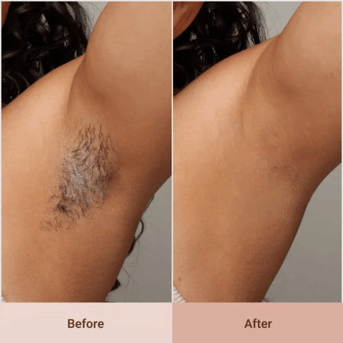 LoweSkin Laser Epilator customer~Kate – Florida, USA