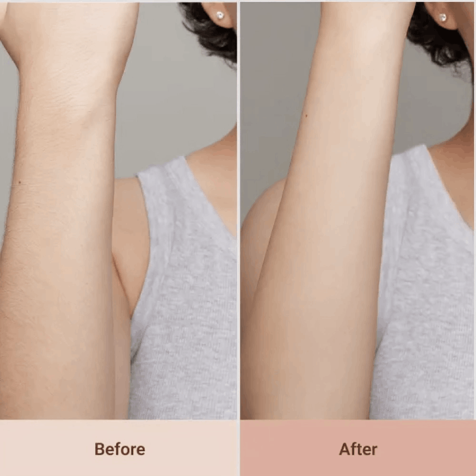 LoweSkin Laser Epilator customer~Lisa  – Illinois, USA